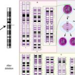 Deletion Mutation - Definition, Causes, Mechanism, Examples