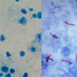 Acid Fast Stain - Principle, Reagents, Procedure, Result