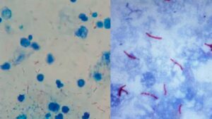 Acid Fast Stain – Principle, Reagents, Procedure, Result