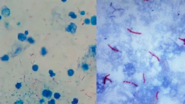 Acid Fast Stain - Principle, Reagents, Procedure, Result