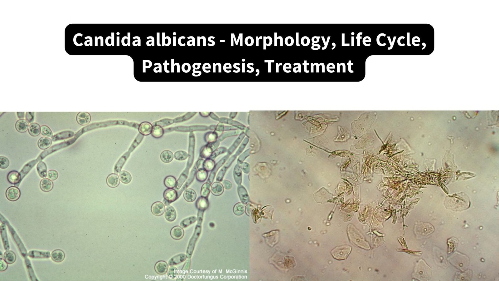 Candida albicans - Morphology, Life Cycle, Pathogenesis, Treatment
