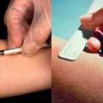 Mantoux Test - Procedure, Normal Range and Result Interpretation
