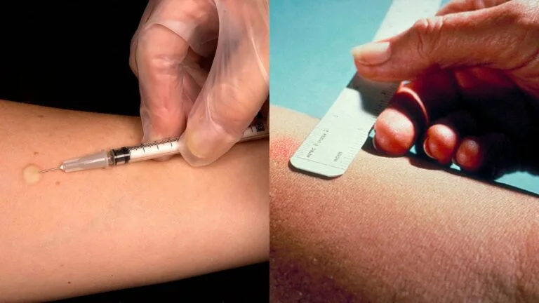 Mantoux Test - Procedure, Normal Range and Result Interpretation