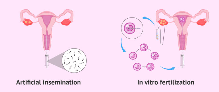 Assisted Reproductive Technology - Techniques, Importance