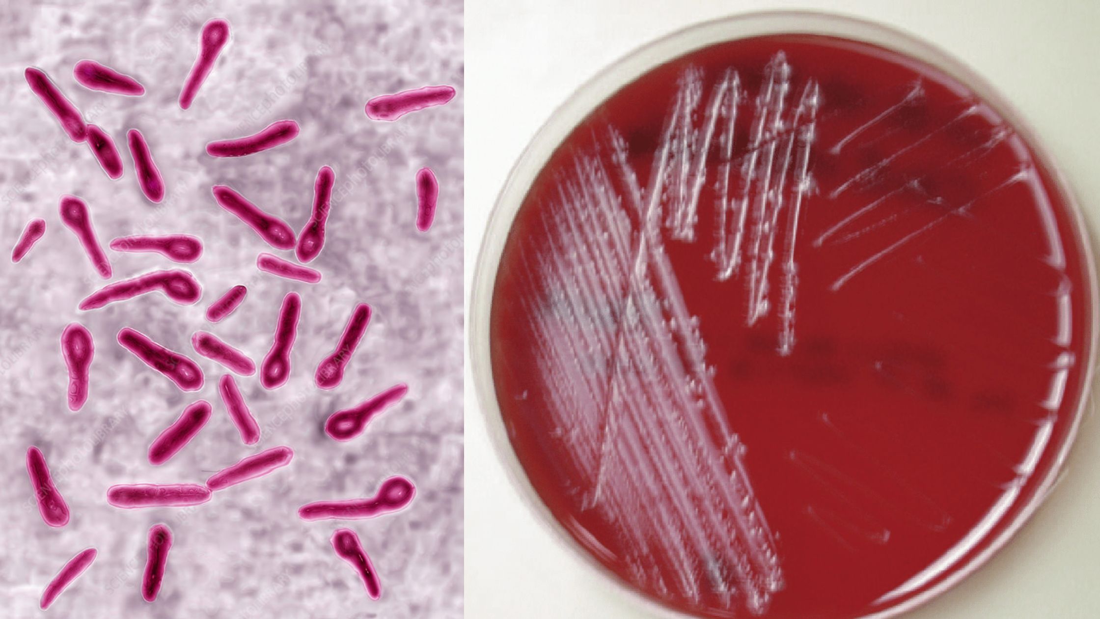 Clostridium tetani - Overview