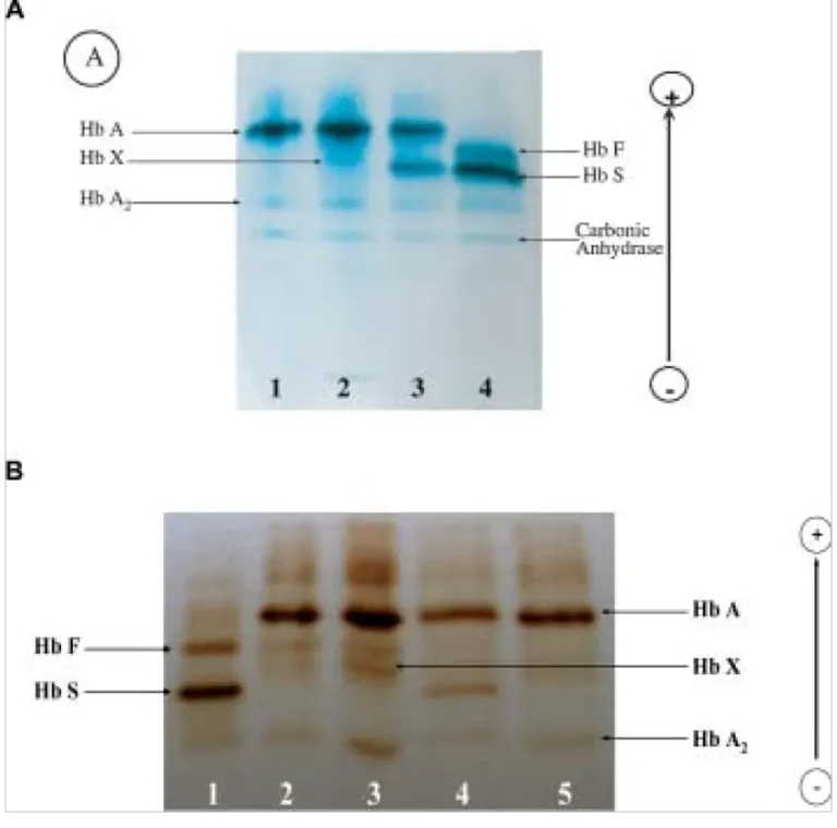 Cellulose Acetate Electrophoresis - Definition, Principle, Operating Procedure, Uses