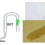 Hyaline Casts in Urine: Types, Morphology, Clinical Significance