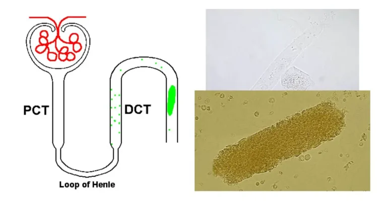 Hyaline Casts in Urine: Types, Morphology, Clinical Significance