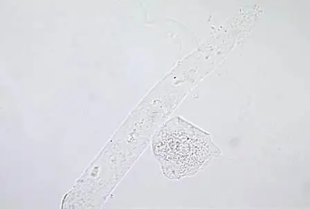 Hyaline Casts
