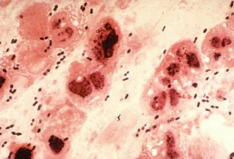 Streptococcus pneumoniae - Habitat, Morphology, Genomes 1 Gram Stain of a film of sputum from a case of lobar pneumonia. CDC.