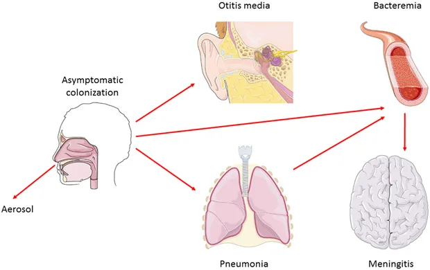 Streptococcus pneumoniae - Habitat, Morphology, Genomes 2 Schematic depiction of the spread and progression of Streptococcus pneumonia infection (Loughran AJ, et al. 2019