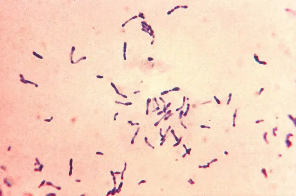 This photomicrograph displayed a number of methylene blue-stained Gram-positive Corynebacterium diphtheriae bacteria. The sample was collected from a Pai’s oblique culture. Diphtheria is an acute bacterial infection induced by toxigenic strains of Corynebacterium diphtheriae and, on occasion, C. ulcerans. The disease is transmitted via respiratory secretions and direct contact. Diphtheria affects the mucous membranes of the respiratory tract (known as “respiratory diphtheria”), the skin (known as “cutaneous diphtheria”), and occasionally other locations such as the eyes, nose, or vagina. Diphtheria continues to be a serious disease in the majority of the globe. In the 1990s, significant diphtheria outbreaks occurred throughout Russia and the other former Soviet republics. The majority of life-threatening cases occurred in unvaccinated individuals. Travelers to disease-endemic regions are more likely to be exposed to toxigenic C. diphtheriae strains.
