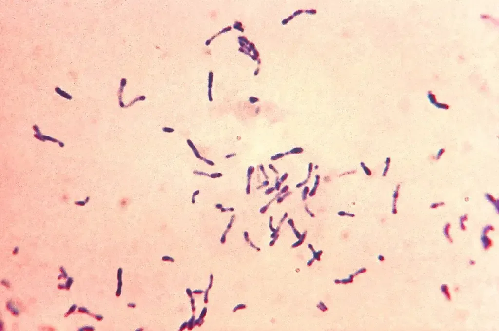 This photomicrograph displayed a number of methylene blue-stained Gram-positive Corynebacterium diphtheriae bacteria. The sample was collected from a Pai’s oblique culture. Diphtheria is an acute bacterial infection induced by toxigenic strains of Corynebacterium diphtheriae and, on occasion, C. ulcerans. The disease is transmitted via respiratory secretions and direct contact. Diphtheria affects the mucous membranes of the respiratory tract (known as “respiratory diphtheria”), the skin (known as “cutaneous diphtheria”), and occasionally other locations such as the eyes, nose, or vagina. Diphtheria continues to be a serious disease in the majority of the globe. In the 1990s, significant diphtheria outbreaks occurred throughout Russia and the other former Soviet republics. The majority of life-threatening cases occurred in unvaccinated individuals. Travelers to disease-endemic regions are more likely to be exposed to toxigenic C. diphtheriae strains.
