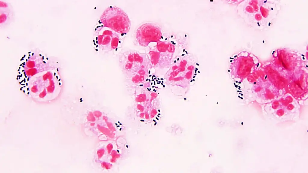 Streptococcus pneumoniae in cerebrospinal fluid sample Gram stained. Image showing encapsulated gram positive diplococci and leukocytes.
Contributed by Sixto M. Leal, Jr., M.D., Ph.D.