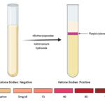 results of Rothera’s test