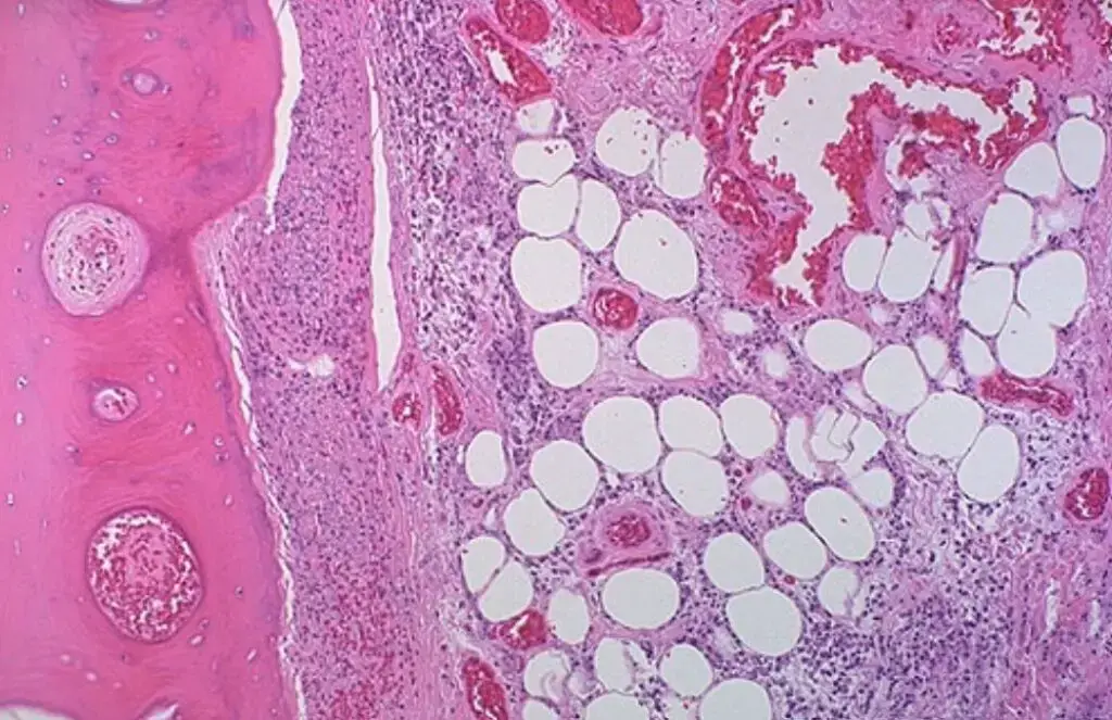 Gangrenous necrosis affects a body part’s tissues. Under the skin of a toe, soft tissue (fat and connective tissue on the right) and bone are inflamed in this image (at the left). Multiple non-viable tissues necessitate the amputation of such locations. | Figure from: The University of Utah Eccles Health Sciences Library.