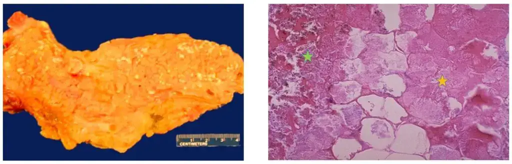 Left: Demonstrates fat necrosis of the pancreas. Saponification has occurred and these appear grossly as the soft, chalky white areas. Right: Microscopically, fat necrosis adjacent to the pancreas is seen here. There are some remaining steatocytes at the left which are not necrotic, as seen as a green star. The necrotic fat cells at the right have vague cellular outlines, have lost their peripheral nuclei, and their cytoplasm has become a pink amorphous mass of necrotic material, as seen as a yellow star. | Figure from: The University of Utah Eccles Health Sciences Library.
