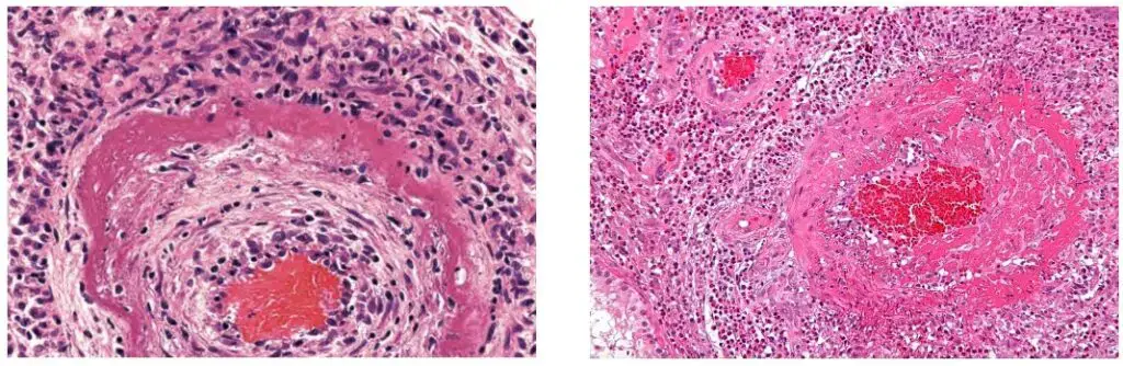 Left: Demonstrates an artery that is surrounded by a bright ring of necrosis. Inflammation should be present. Right: Demonstrates a micrograph showing (intensely pink) fibrinoid necrosis (large blood vessel – right of image) in a case of vasculitis. H&E stain was used.