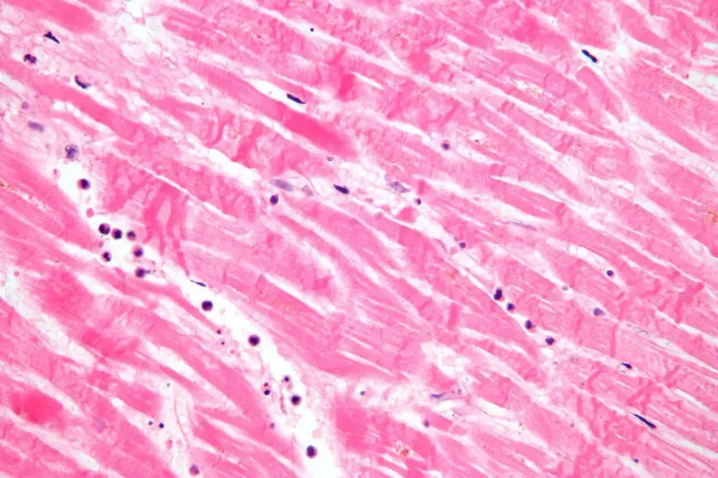 Karyolysis (and contraction band necrosis) in myocardial infarction (heart attack) | Image Source: Wikipedia
