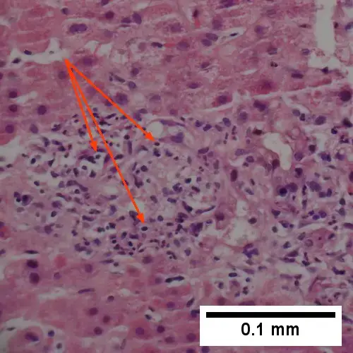 Pyknosis in a bile infarct
