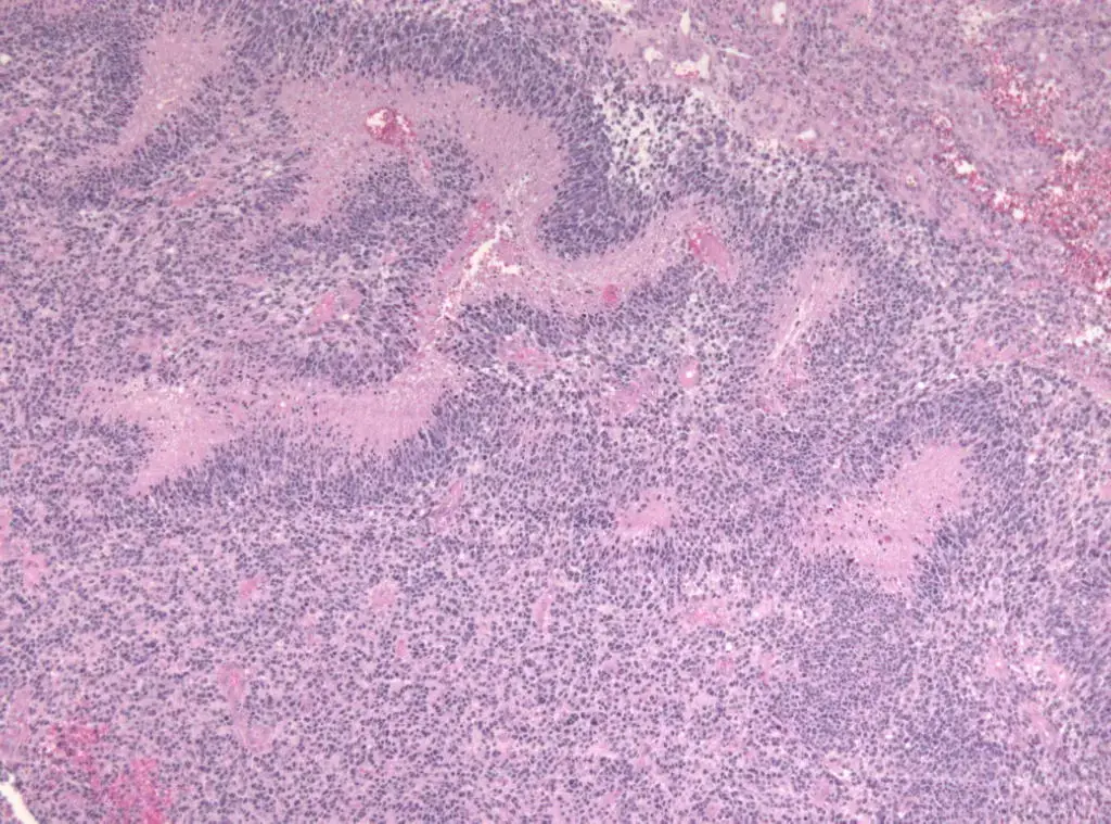 Pseudopalisading seen around necrosis in glioblastoma
