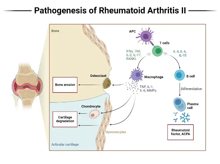 Pathogenesis of Rheumatoid Arthritis II (with Callout)
