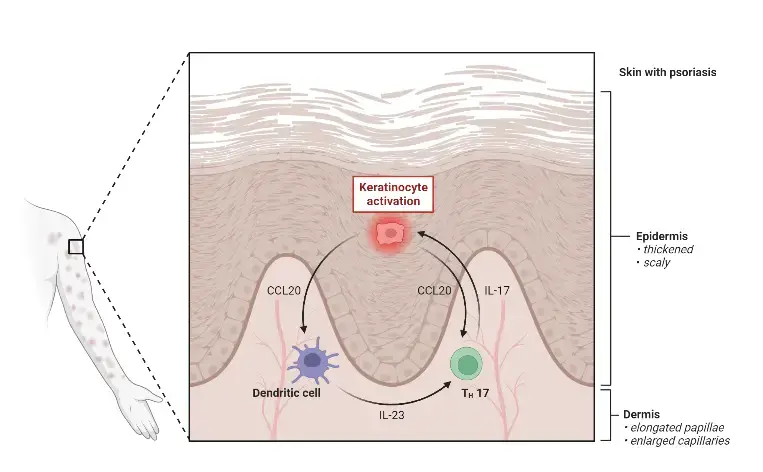 The IL-23_IL-17 Axis in Psoriasis
