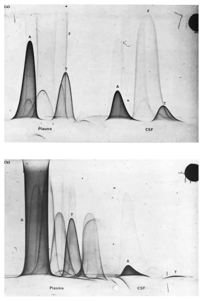 Two dimensional immunoelectrophoresis of 60-day foetal sheep plasma and CSF (a) and adult sheep plasma and CSF (b). A, albumin; T, transferrin; F, fetuin.

