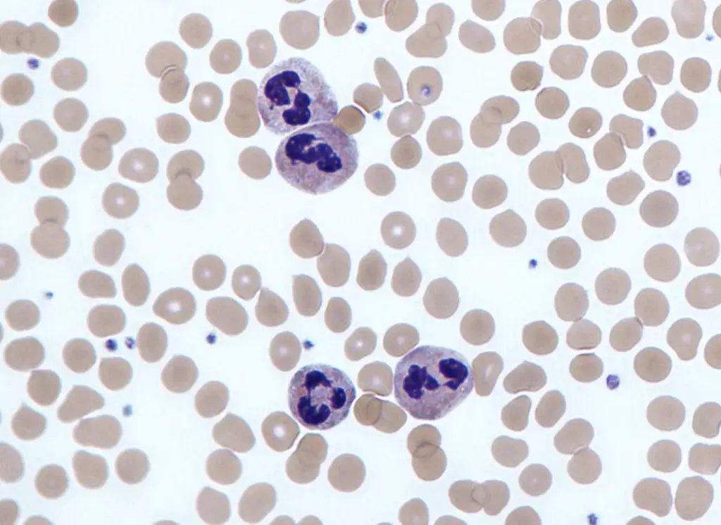 Neutrophils with segmented nuclei surrounded by erythrocytes and platelets. Intra-cellular granules are visible in the cytoplasm (Giemsa stained).