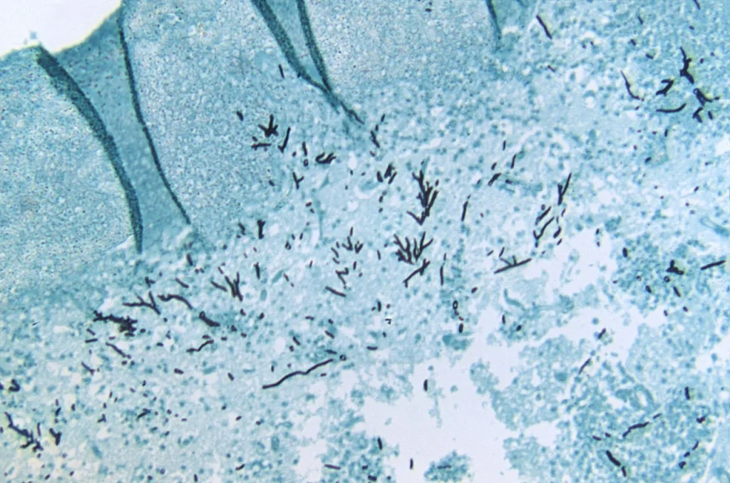 Aspergillus fumigatus Images – Slide of an infected turkey brain