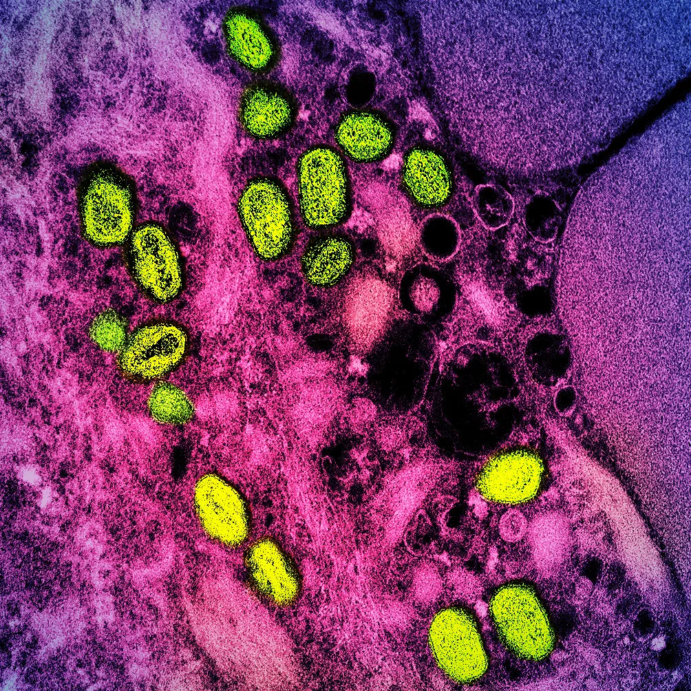 Monkeypox virus pics – Colorized transmission electron micrograph of monkeypox particles (green) found within an infected cell (pink and purple), cultured in the laboratory. Image captured at the NIAID Integrated Research Facility (IRF) in Fort Detrick, Maryland. Credit: NIAID