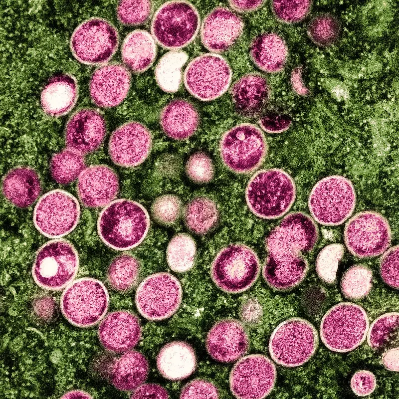 Monkeypox virus pics – Colorized transmission electron micrograph of monkeypox particles (pink) found within an infected cell (green), cultured in the laboratory. Image captured and color-enhanced at the NIAID Integrated Research Facility (IRF) in Fort Detrick, Maryland. Credit: NIAID
