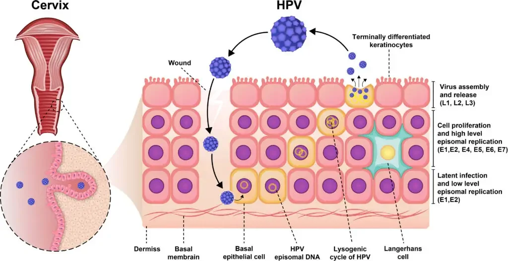 The aetiology of HPV infection. Initially, the virus was dormant within the epithelial cell and proliferated slowly. The rate of proliferation increases as the virus enters the lysogenic cycle. Ultimately, keratinocytes combine and produce viruses to continue the infection cycle. | Image Source: Zahra Yousefi et al. 2022.
