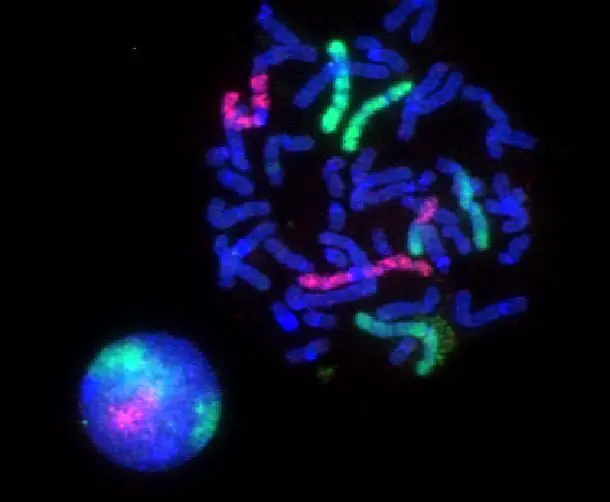 Fluorescence Microscopy Images – Fluorescence microscopy images of sun flares pathology in a blood cell showing the affected areas in red.