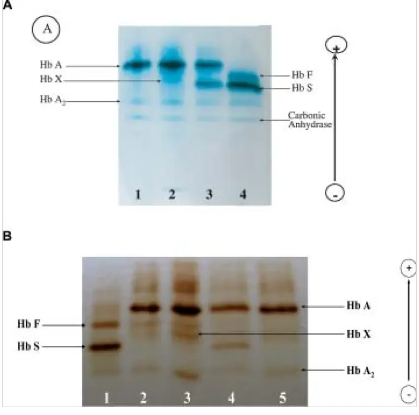 Electrophoresis research. A) Electrophoresis of cellulose acetate at an alkaline pH. Lane 1: normal adult control; lane 2: proband; lane 3: sickle cell trait control; lane 4: homozygous sickle cell. B) Isoelectric polyacrylamide gel concentration Lane 1: sickle cell homozygous; Lane 2: -thal trait and Hb X lane 3: proband; lane 4: sickle cell trait control; lane 5: normal adult control.