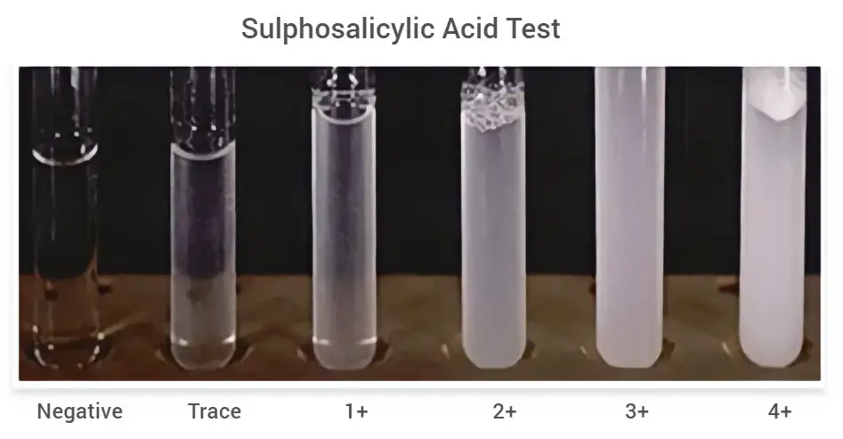 Sulphosalicylic Acid Test for Proteinuria: Principle, Procedure, Result, Uses
