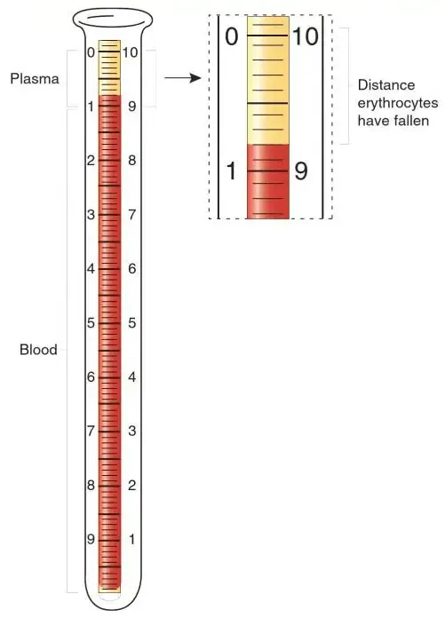 Wintrobe’s method of Erythrocyte Sedimentation Rate (ESR)
