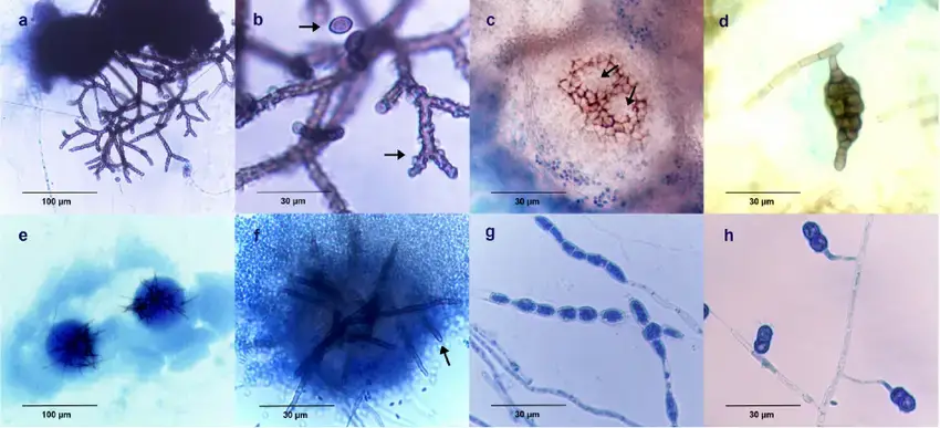 Observation of fungal structures embedded under the agar surface in agar block smears. (a) Chaetomium funicola , showing the ascomata with typical straight, stiff, dichotomously branched ascomal hairs partially embedded in agar. (b) Chaetomium globosum , showing the distinctly verrucose ascomal hairs (arrow) and its limoniform ascospore (arrow). (c and d) Phoma glomerata , showing a spherical pycnidium partially embedded under the agar surface with two ostioles (arrows) and a brown chlamydospore with longitudinal and transverse septa. (e and f) Pyrenochaeta unguis-hominis , showing the characteristic setose pycnidium and setae with obtuse apices (arrow). (g) Fusarium dimerum , showing the intercalary ovoidal chlamydospores arranged in chains. (h) Fusarium solani , showing the lateral spherical chlamydospores arranged in pairs.
