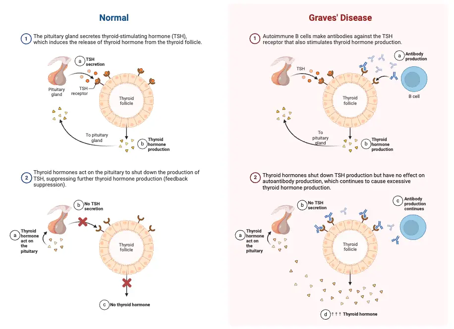 Graves' Disease