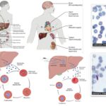 Malaria - Parasite, Life Cycle, Pathogenesis, Diagnosis, Treatment, Prophylaxis