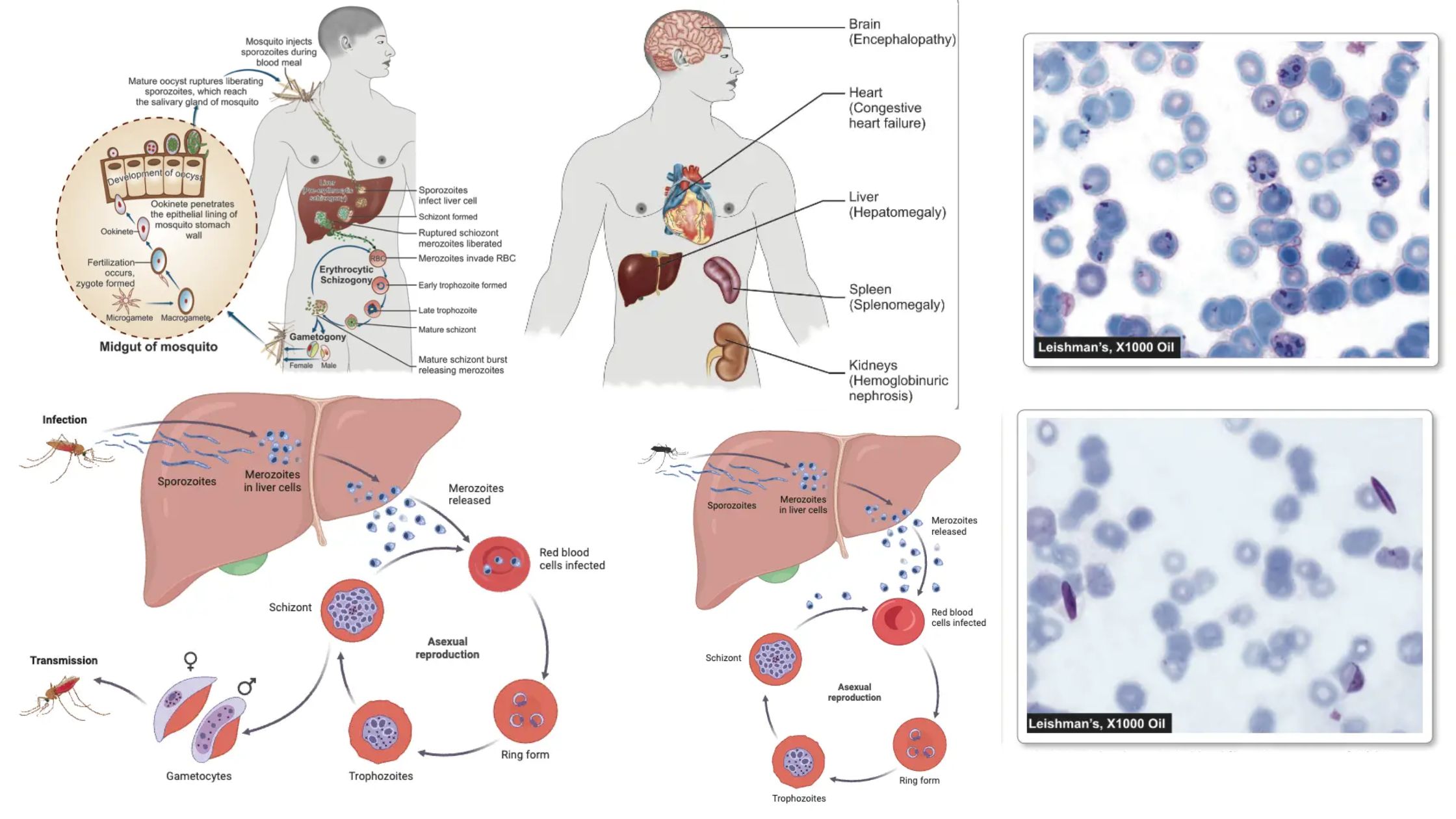 Malaria - Parasite, Life Cycle, Pathogenesis, Diagnosis, Treatment, Prophylaxis