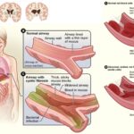 Molecular Basis of Diagnosis of Genetic Diseases - Cystic Fibrosis, Huntington’s, Sickle Cell Anaemia