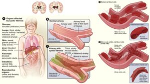 Molecular Basis of Diagnosis of Genetic Diseases – Cystic Fibrosis, Huntington’s, Sickle Cell Anaemia