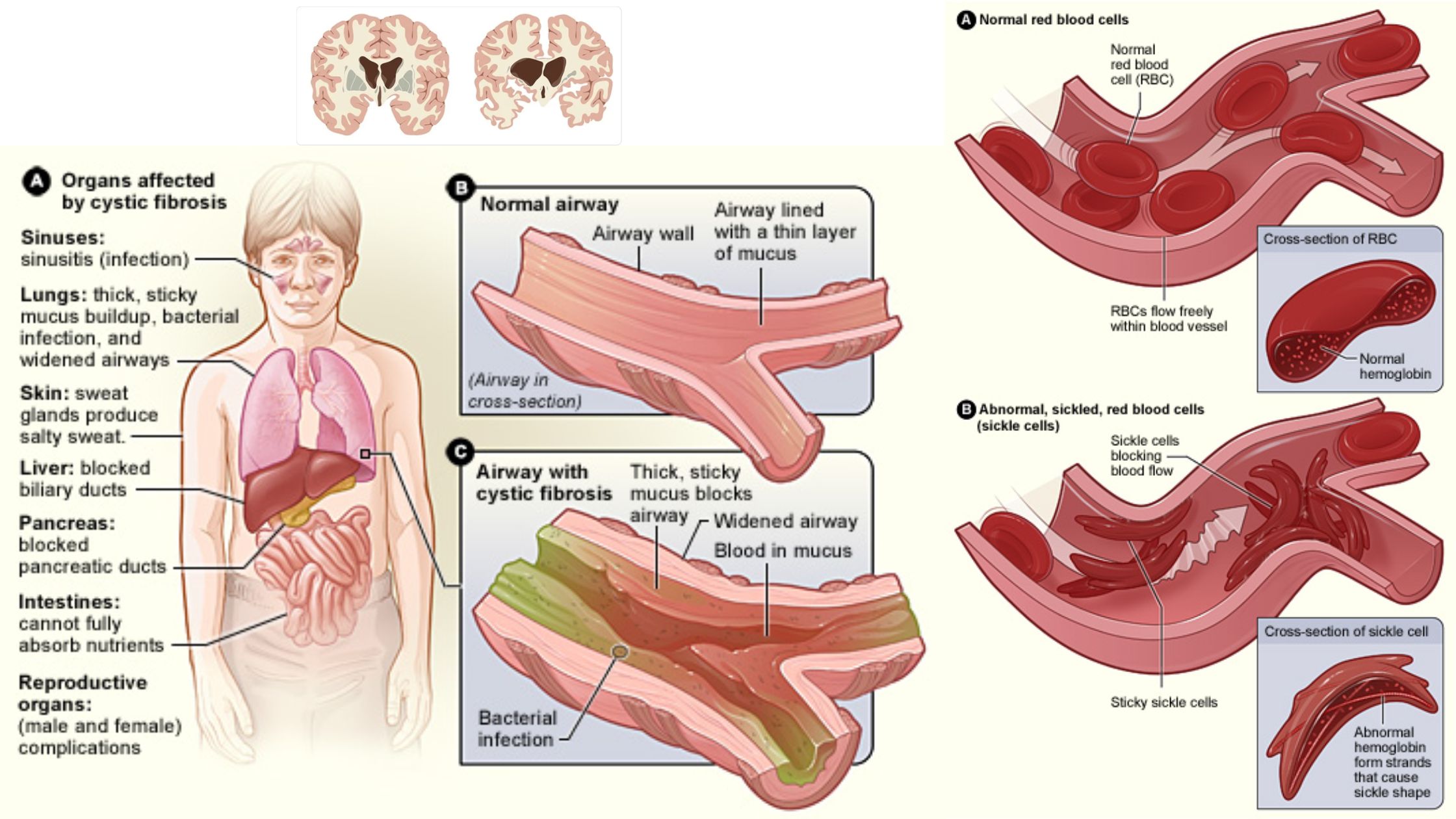 Molecular Basis of Diagnosis of Genetic Diseases - Cystic Fibrosis, Huntington’s, Sickle Cell Anaemia