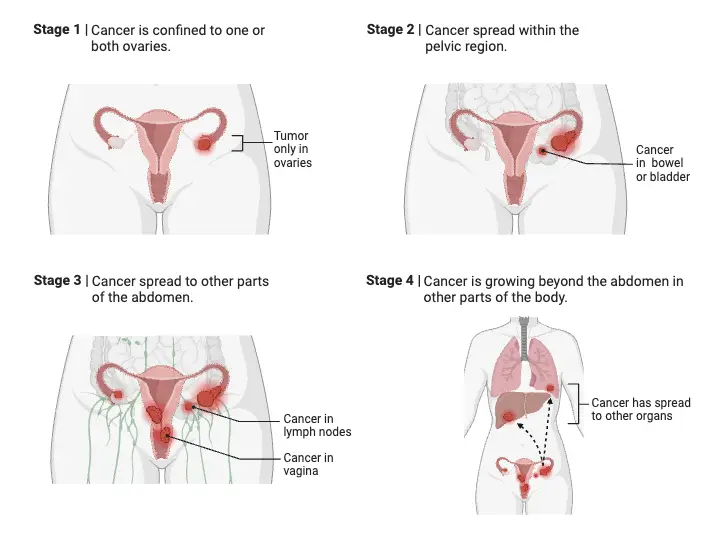 Ovarian Cancer Staging