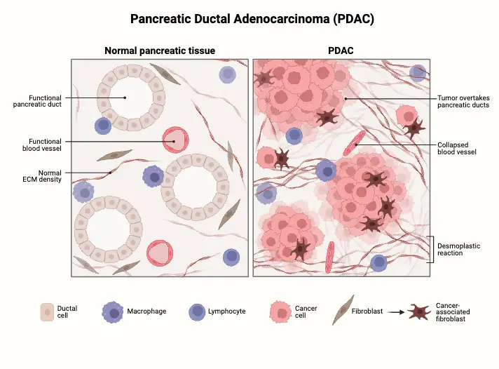 PDAC Histology