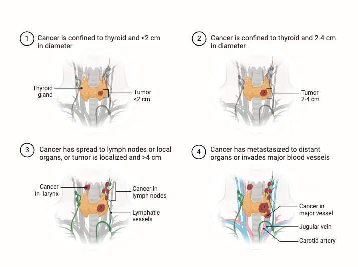 Thyroid Cancer Staging