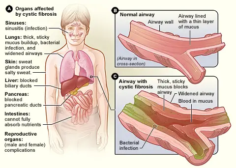 Cystic Fibrosis or mucoviscidosis