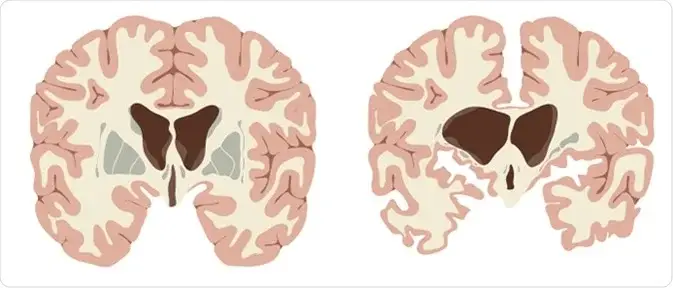 Normal brain and brain with Huntington's disease, showing enlarged ventricles and atrophy of nerve tissue and basal ganglia.