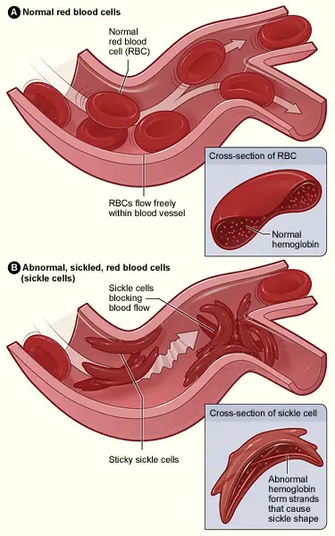 A shows normal red blood cells flowing freely in a blood vessel. The inset image shows a cross-section of a normal red blood cell with normal hemoglobin. Figure B shows abnormal, sickled red blood cells blocking blood flow in a blood vessel. 